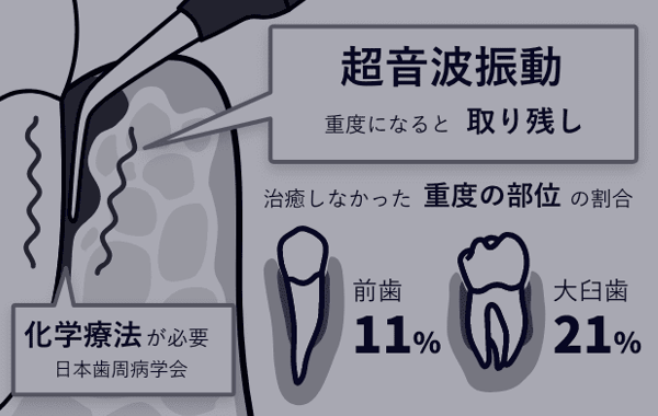 超音波振動の取り残し