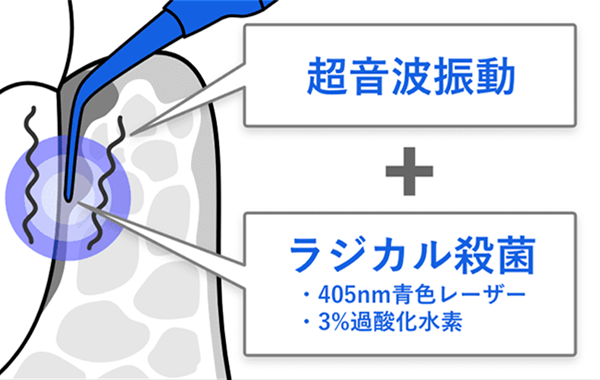 超音波振動+ラジカル殺菌