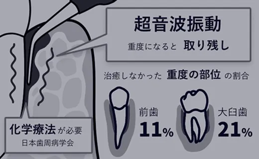 従来の治療法～超音波振動のみの治療