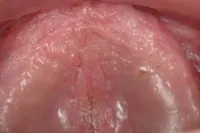 症例1 1